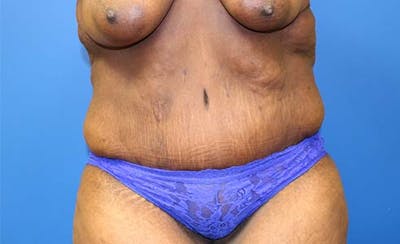 Abdominoplasty Before & After Gallery - Patient 130056 - Image 2
