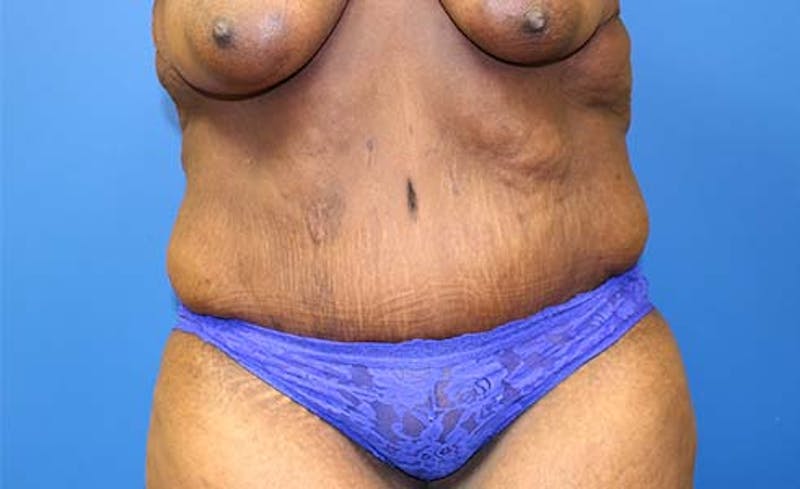 Abdominoplasty Before & After Gallery - Patient 130056 - Image 2
