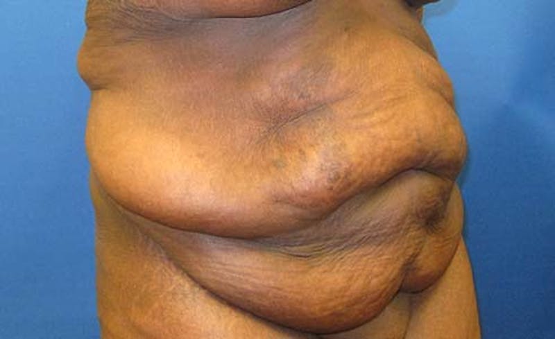 Abdominoplasty Before & After Gallery - Patient 130056 - Image 3