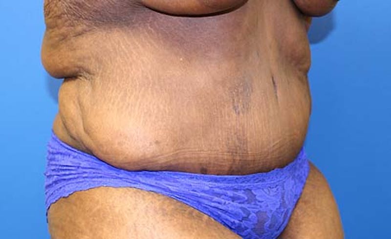 Abdominoplasty Before & After Gallery - Patient 130056 - Image 4