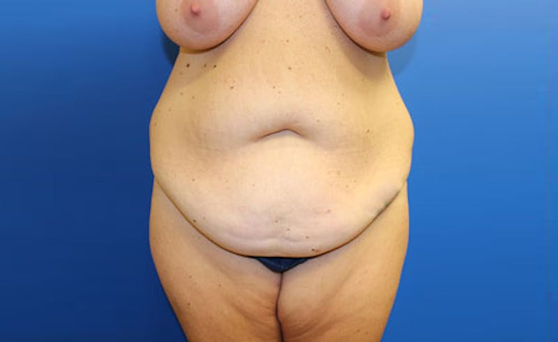 Abdominoplasty Before & After Gallery - Patient 279929 - Image 1