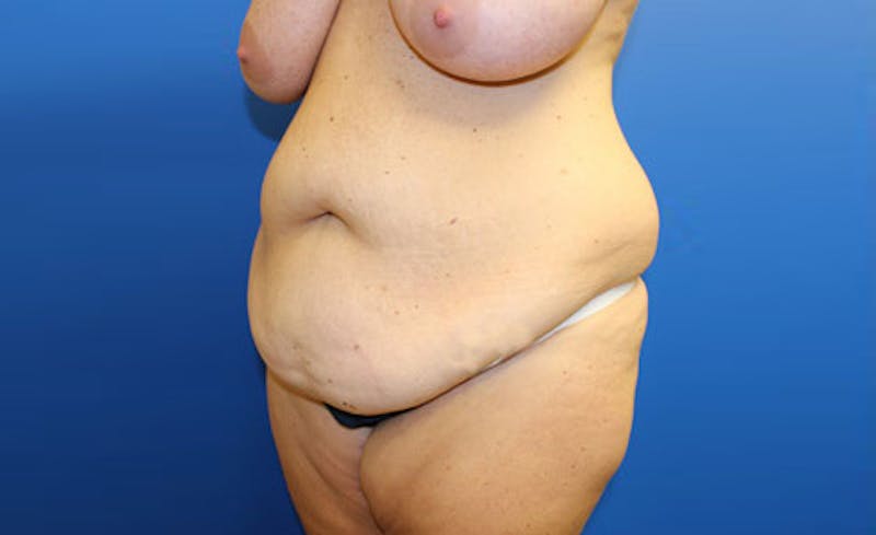 Abdominoplasty Before & After Gallery - Patient 279929 - Image 3