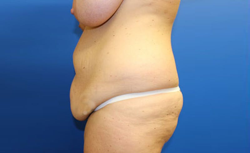 Abdominoplasty Before & After Gallery - Patient 279929 - Image 5