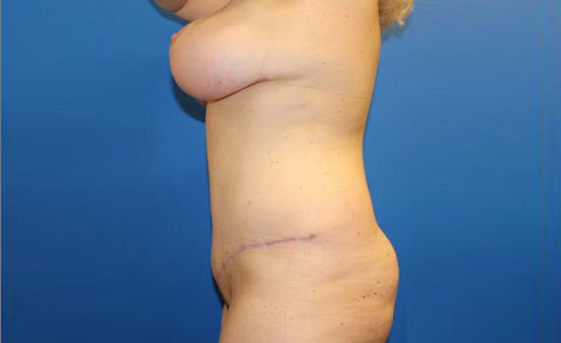 Abdominoplasty Before & After Gallery - Patient 279929 - Image 6