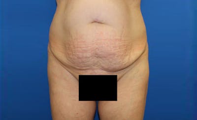 Abdominoplasty Before & After Gallery - Patient 166280 - Image 1