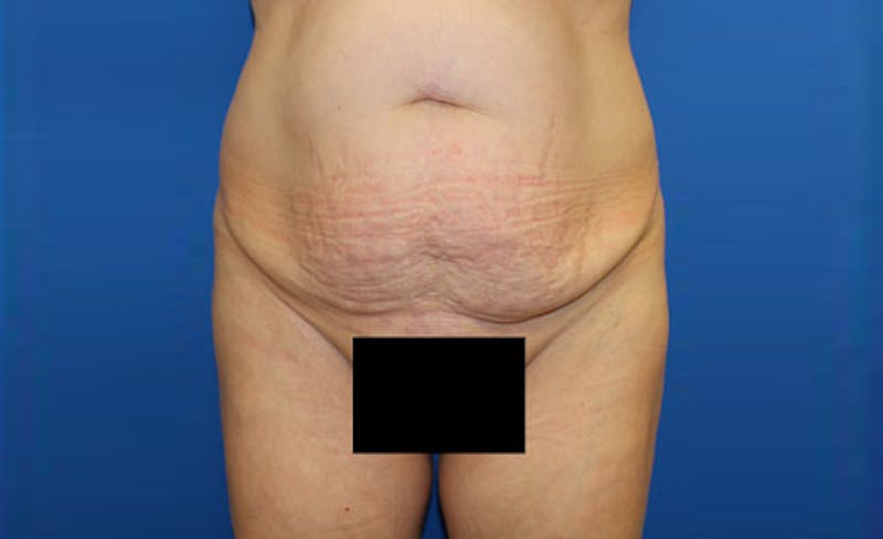 Abdominoplasty Before & After Gallery - Patient 166280 - Image 1