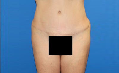Abdominoplasty Before & After Gallery - Patient 166280 - Image 2