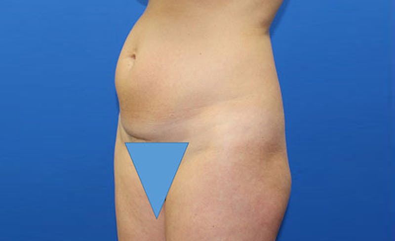 Abdominoplasty Before & After Gallery - Patient 358109 - Image 3