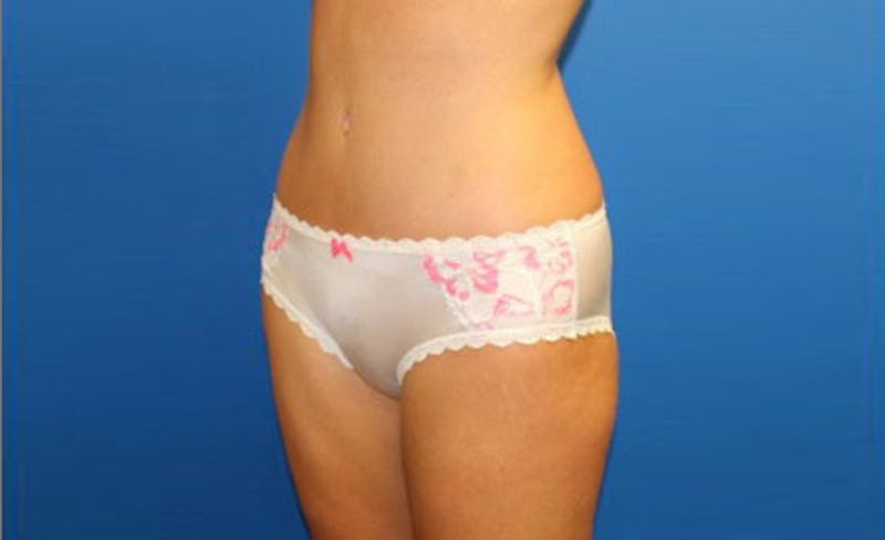 Abdominoplasty Before & After Gallery - Patient 358109 - Image 4