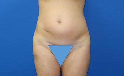 Abdominoplasty Before & After Gallery - Patient 358109 - Image 1