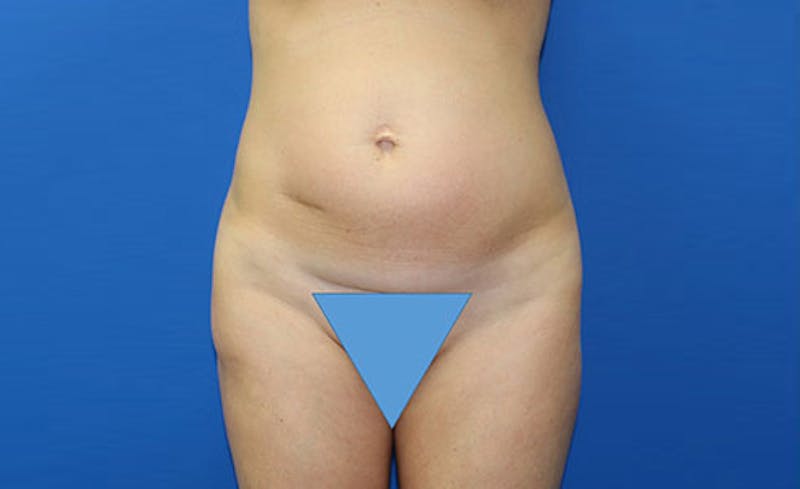 Abdominoplasty Before & After Gallery - Patient 358109 - Image 1