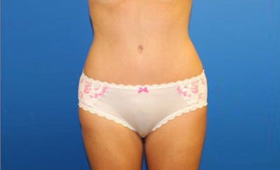 Abdominoplasty Before & After Gallery - Patient 358109 - Image 2