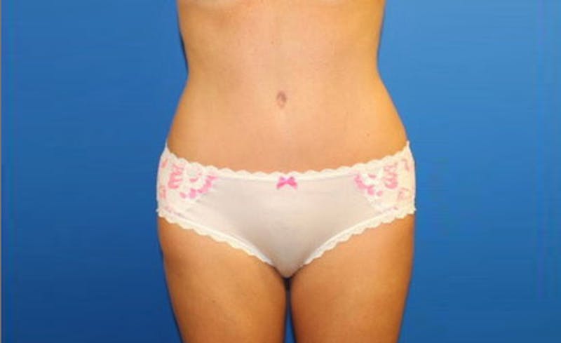 Abdominoplasty Before & After Gallery - Patient 358109 - Image 2