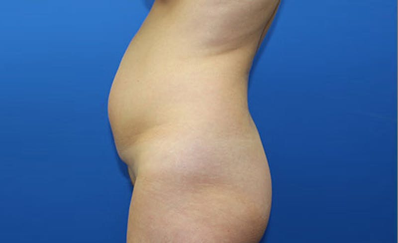 Abdominoplasty Before & After Gallery - Patient 358109 - Image 5
