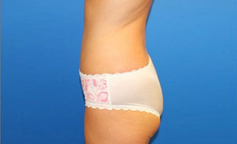 Abdominoplasty Before & After Gallery - Patient 358109 - Image 6