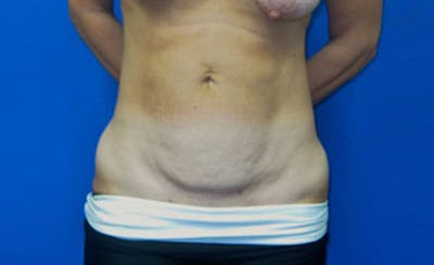 Abdominoplasty Before & After Gallery - Patient 931682 - Image 1