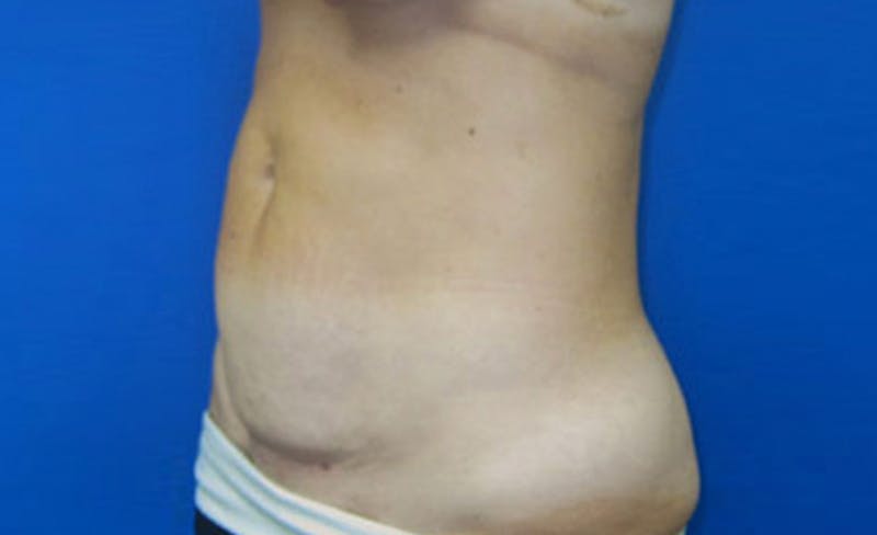 Abdominoplasty Before & After Gallery - Patient 931682 - Image 3