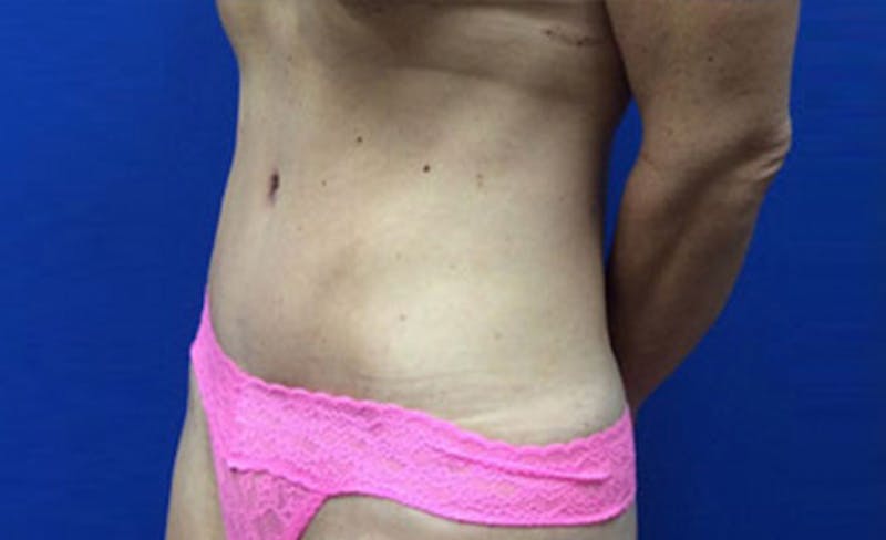 Abdominoplasty Before & After Gallery - Patient 931682 - Image 4