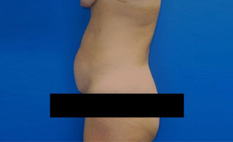 Abdominoplasty Before & After Gallery - Patient 931682 - Image 5