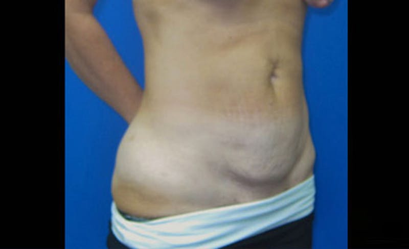 Abdominoplasty Before & After Gallery - Patient 931682 - Image 7