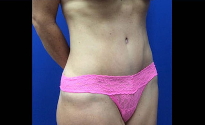 Abdominoplasty Before & After Gallery - Patient 931682 - Image 8