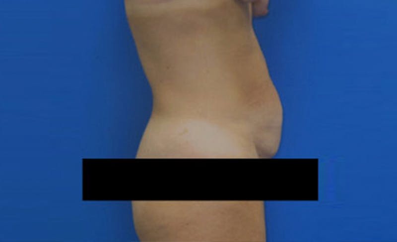 Abdominoplasty Before & After Gallery - Patient 931682 - Image 9