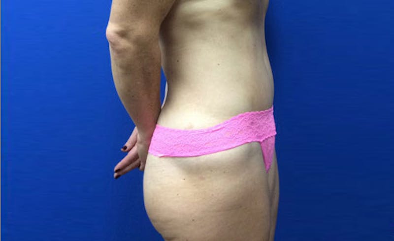 Abdominoplasty Before & After Gallery - Patient 931682 - Image 10