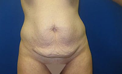Abdominoplasty Before & After Gallery - Patient 306362 - Image 1