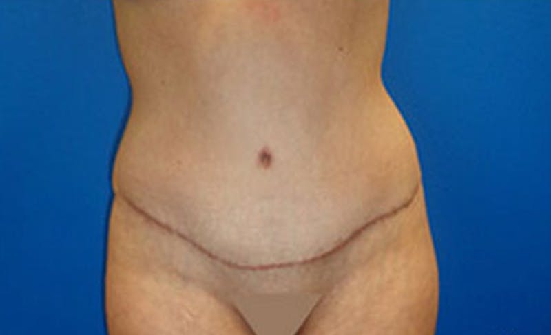 Abdominoplasty Before & After Gallery - Patient 306362 - Image 2