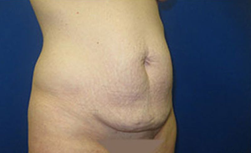 Abdominoplasty Before & After Gallery - Patient 306362 - Image 3