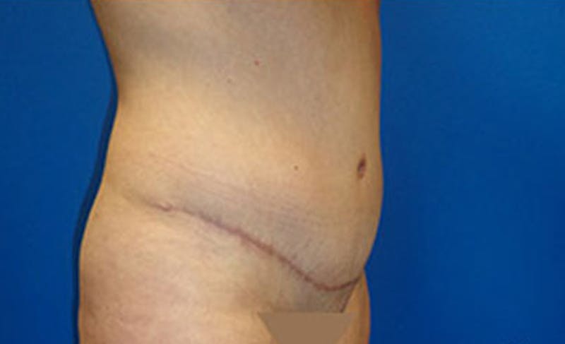 Abdominoplasty Before & After Gallery - Patient 306362 - Image 4