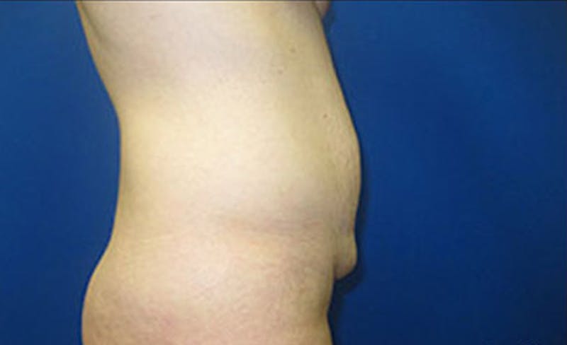 Abdominoplasty Before & After Gallery - Patient 306362 - Image 5