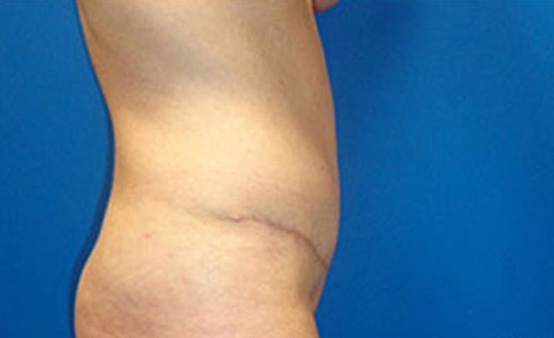 Abdominoplasty Before & After Gallery - Patient 306362 - Image 6
