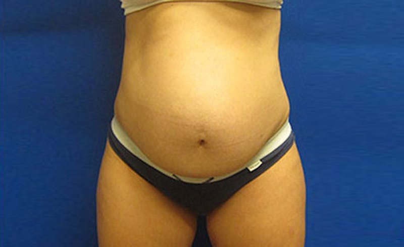Abdominoplasty Before & After Gallery - Patient 112589 - Image 1