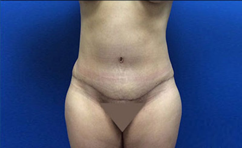 Abdominoplasty Before & After Gallery - Patient 112589 - Image 2