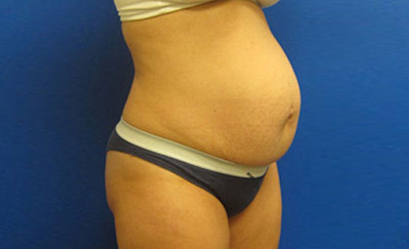 Abdominoplasty Before & After Gallery - Patient 112589 - Image 3