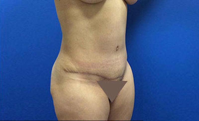 Abdominoplasty Before & After Gallery - Patient 112589 - Image 4