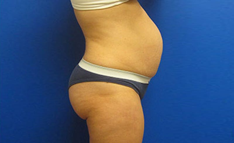 Abdominoplasty Before & After Gallery - Patient 112589 - Image 5