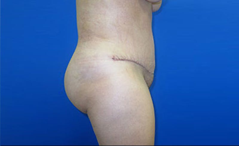Abdominoplasty Before & After Gallery - Patient 112589 - Image 6
