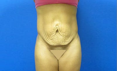 Abdominoplasty Before & After Gallery - Patient 205773 - Image 1