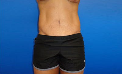 Abdominoplasty Before & After Gallery - Patient 205773 - Image 2