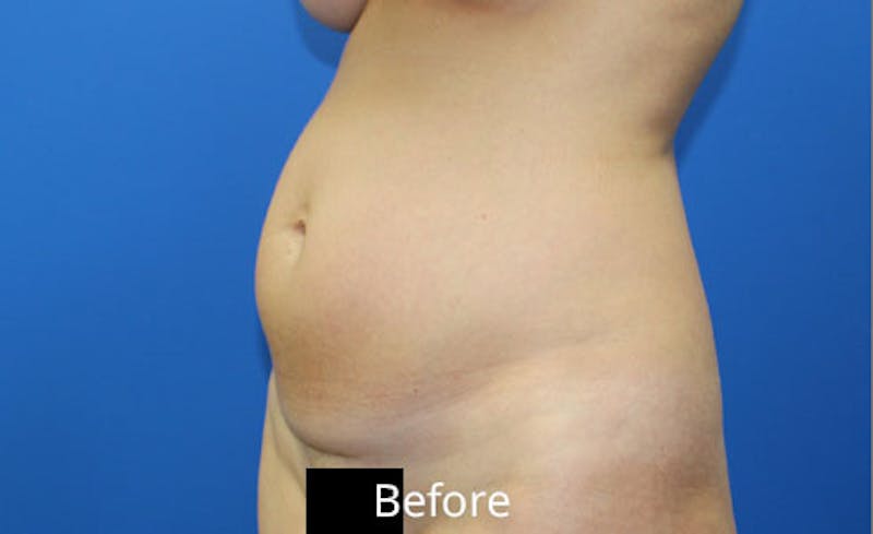 Abdominoplasty Before & After Gallery - Patient 642914 - Image 3