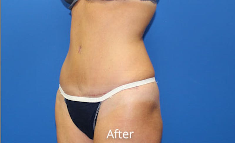 Abdominoplasty Before & After Gallery - Patient 642914 - Image 4