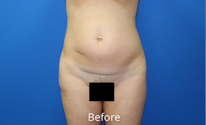 Abdominoplasty Before & After Gallery - Patient 642914 - Image 1