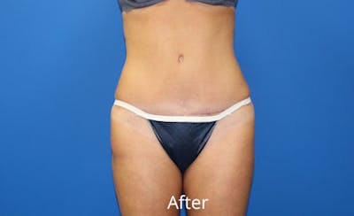 Abdominoplasty Before & After Gallery - Patient 642914 - Image 2