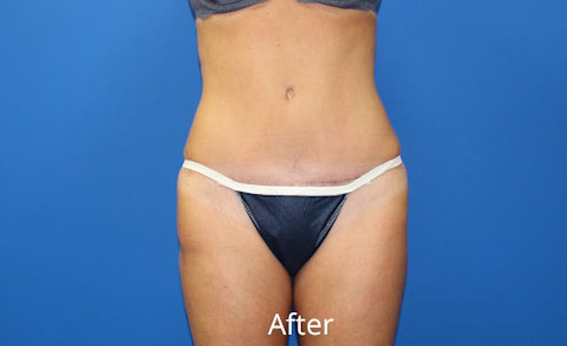 Abdominoplasty Before & After Gallery - Patient 642914 - Image 2