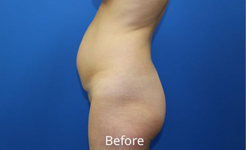 Abdominoplasty Before & After Gallery - Patient 642914 - Image 5