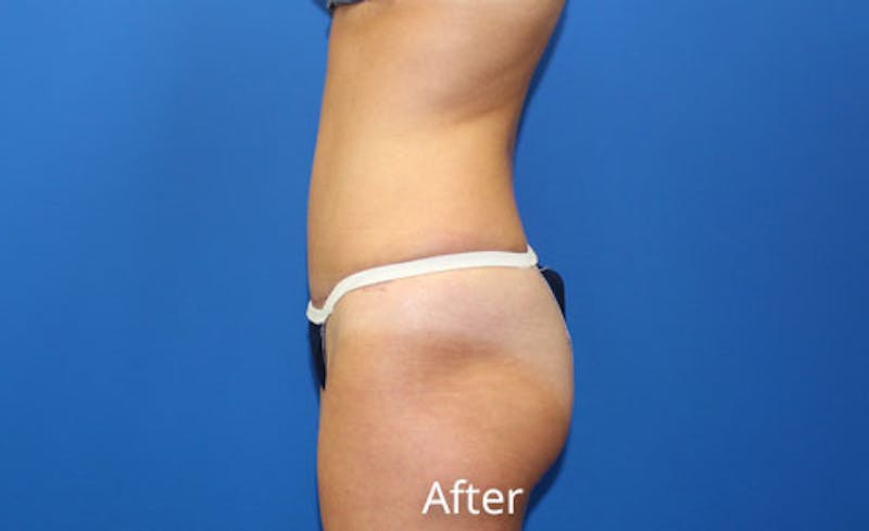 Abdominoplasty Before & After Gallery - Patient 642914 - Image 6