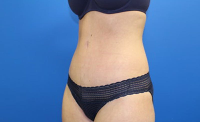 Abdominoplasty Before & After Gallery - Patient 420376 - Image 4