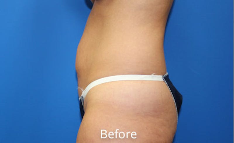 Abdominoplasty Before & After Gallery - Patient 420376 - Image 5